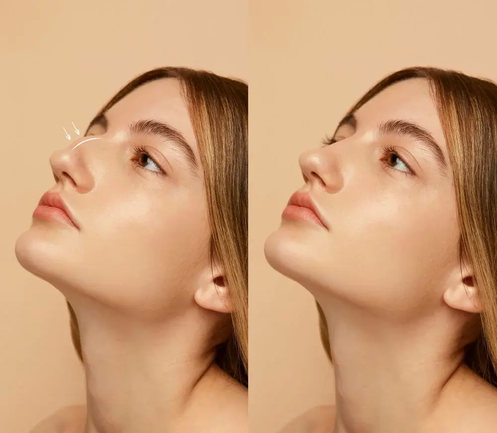 Rinoplastia Ultrasónica